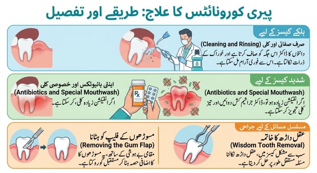 Pericoronitis Treatment Options Explained